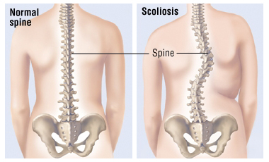 What is Scoliosis and Adult Scoliosis
