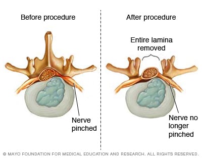 Disc Herniation Sierra Neurosurgery