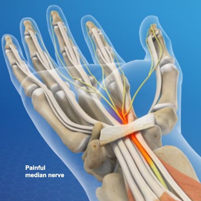 Painful median nerve and carpal tunnel