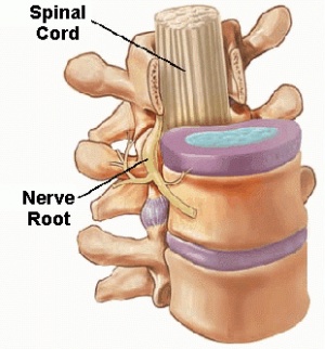 anatomical spinalcord nerveroot body disc anterior view