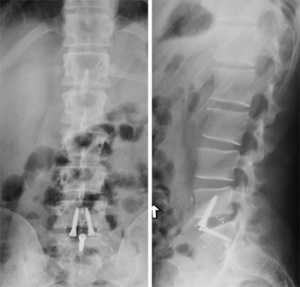 postoperative ALIF X-rays