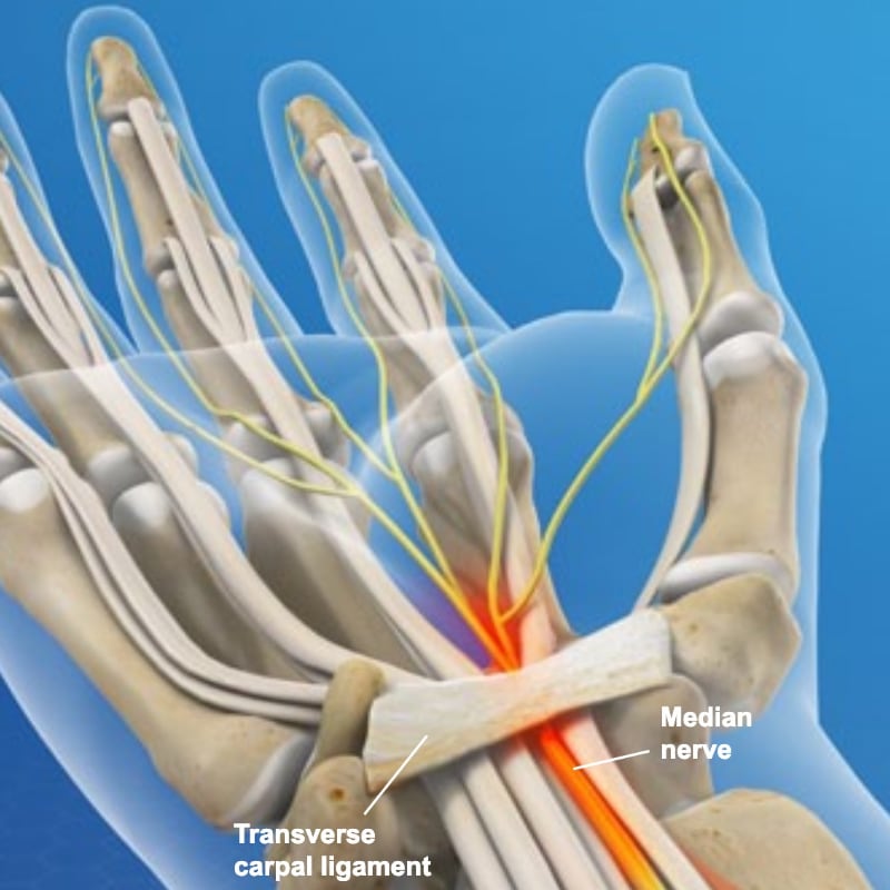 Transverse carpal ligament surgical procedure illustration