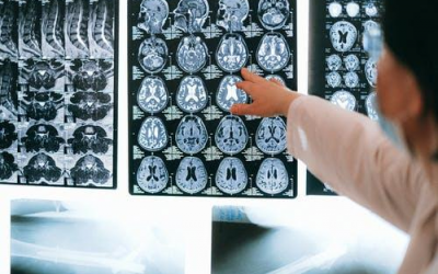 Is Deep Brain Stimulation Effective Against Parkinson’s?