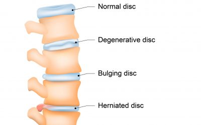 Degenerative Disc Disease of the Spine