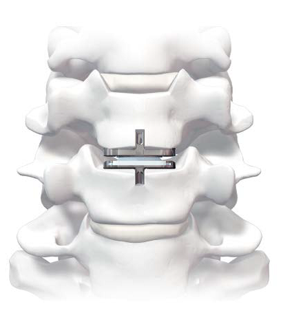 implanted-in-sawbones - prodisc C