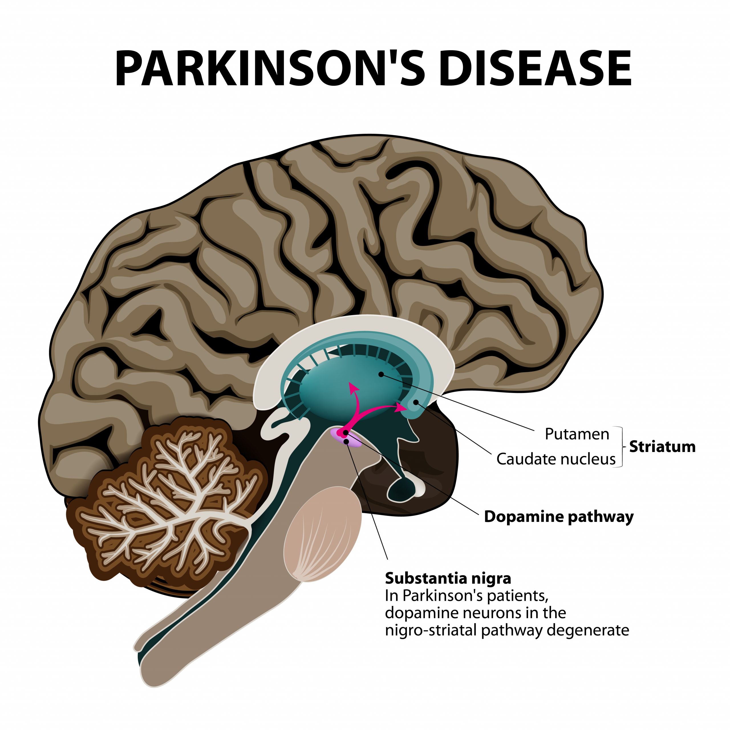 Parkinson's Disease - Cross-section Of The Human Brain